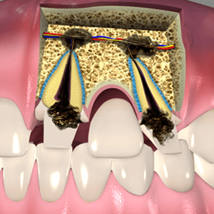 Endodontic Surgery from an endodontist in Raleigh NC